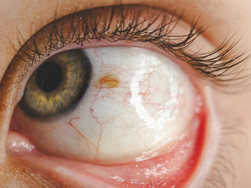 Close em olho com sinais de irritação, ilustrando que algumas doenças da retina do olho tem cura com diagnóstico precoce.
